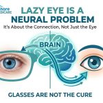 Learn why glasses alone cannot cure amblyopia. Discover how lazy eye affects the brain-eye connection and why specialized pediatric exams are crucial in Lahore.