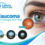 How Does Glaucoma Damage Your Vision Over Time?