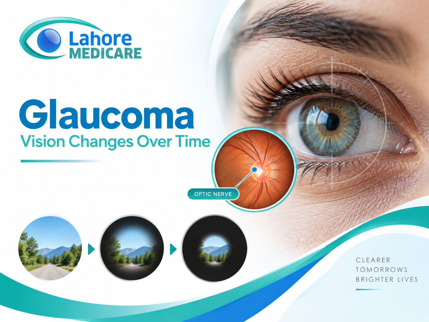 How Does Glaucoma Damage Your Vision Over Time?